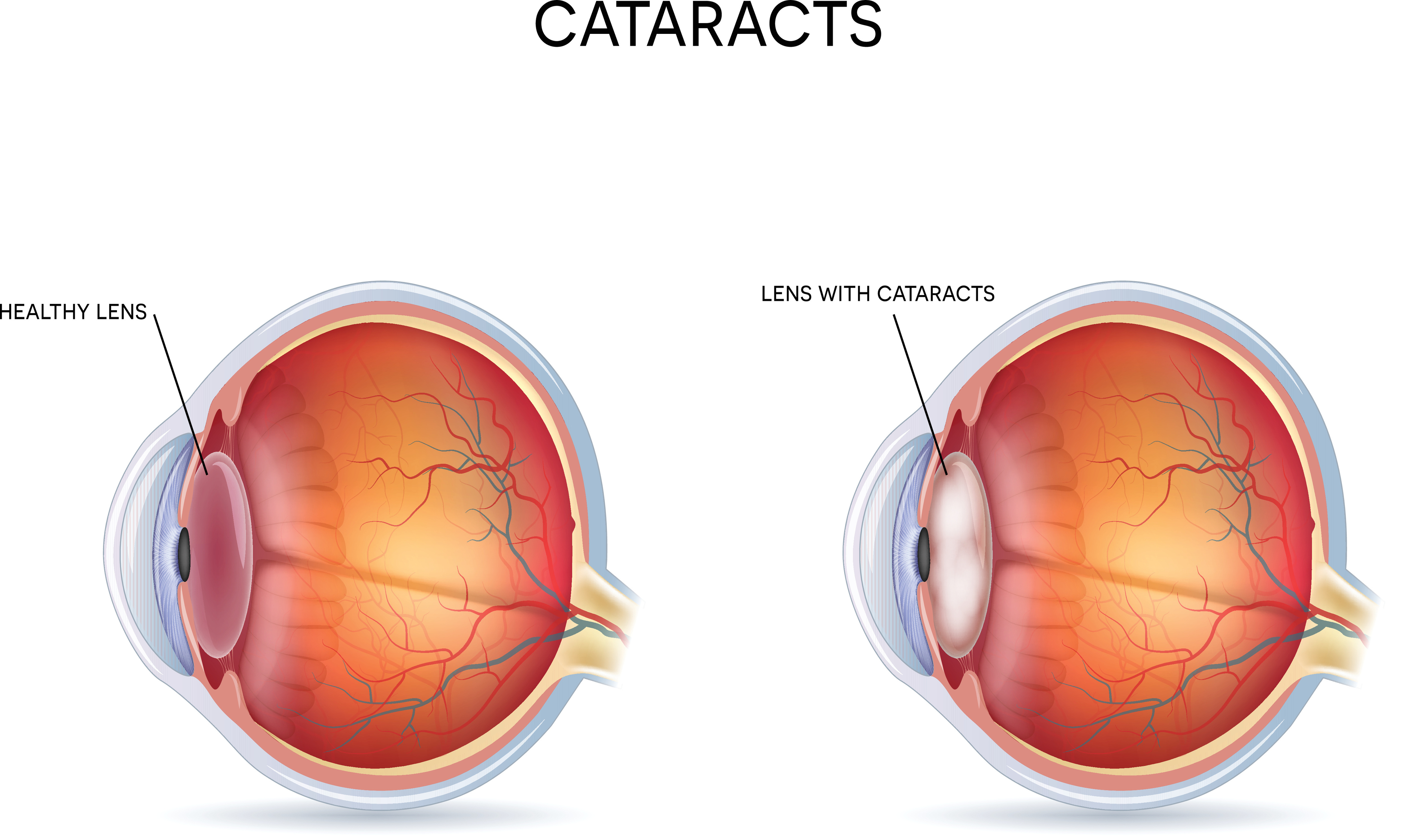 Cataracts