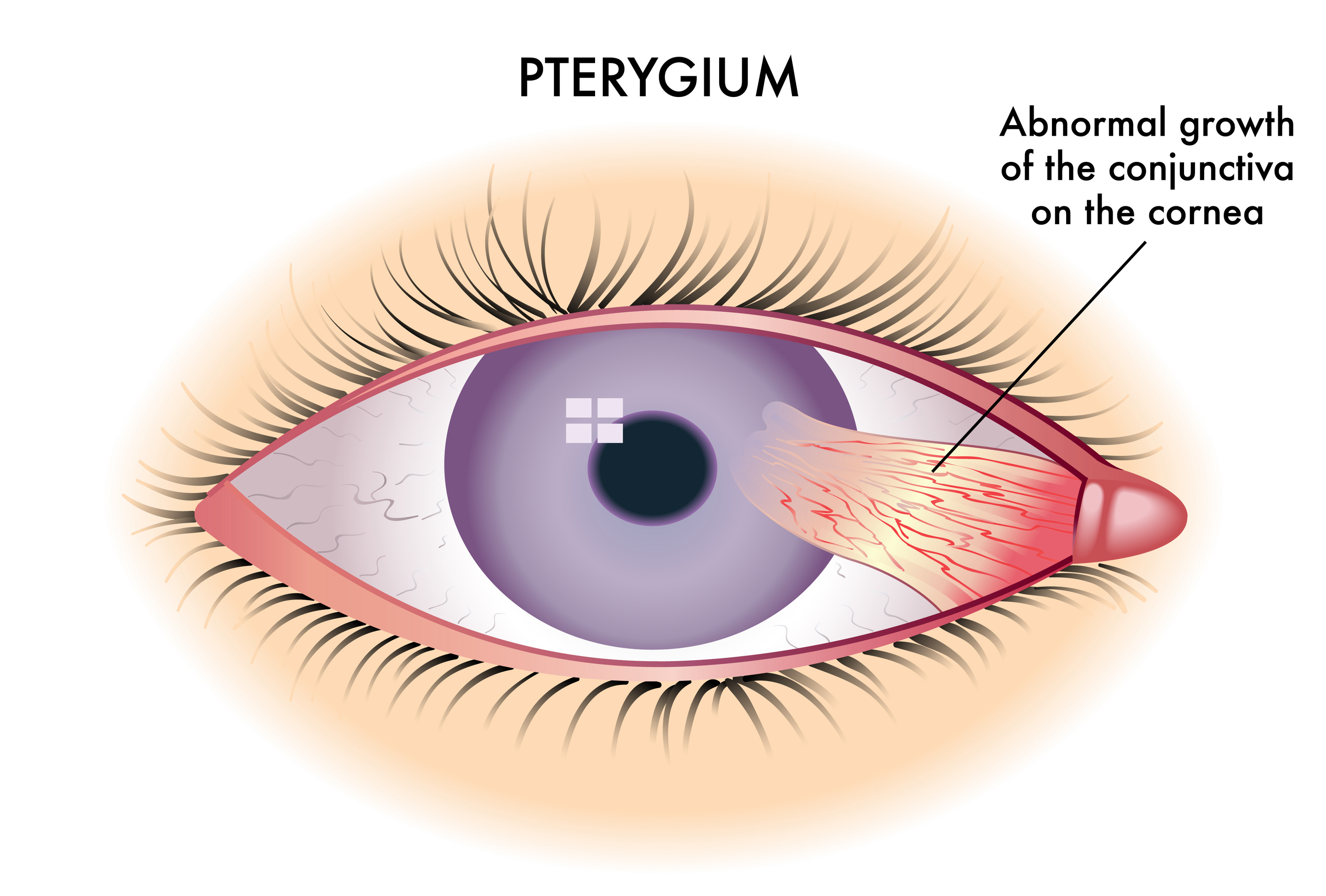 Pterygium