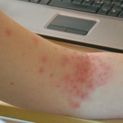 Petechiae