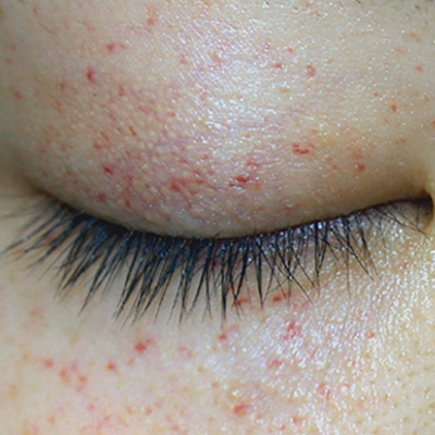Petechiae