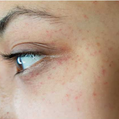 Petechiae