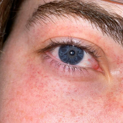 Petechiae