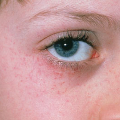 Petechiae