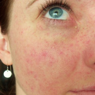 Petechiae