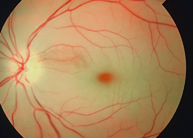 Image of Cherry Red Spot