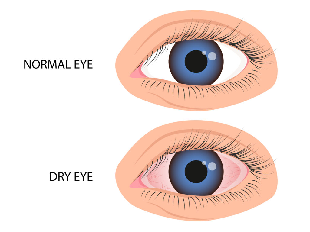 Human eye healthy and dry