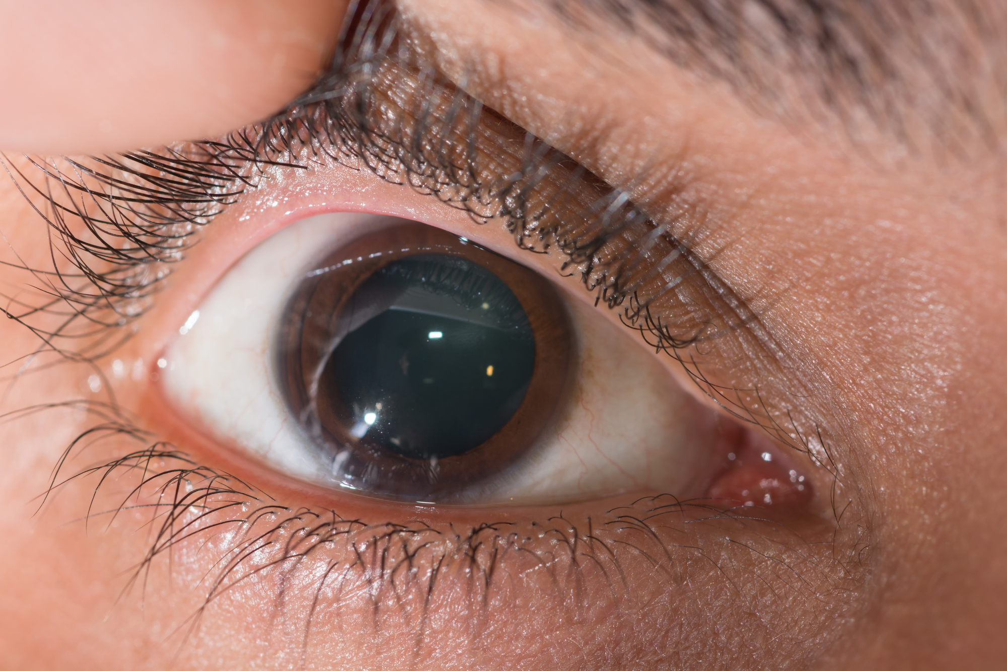 Close up of a dilated pupil during an eye examination