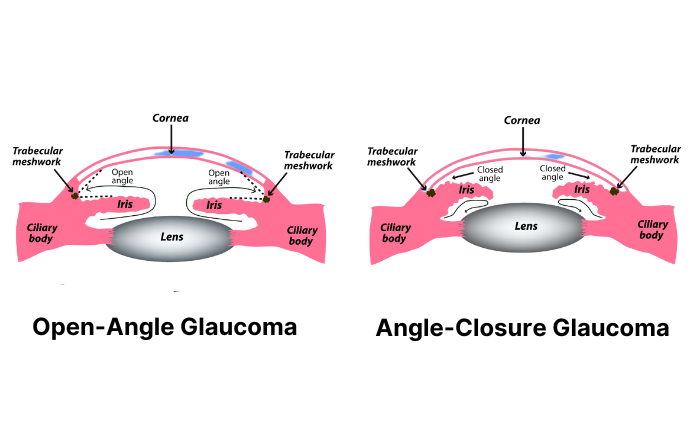 Open angle and angle closure glaucoma illustration edited