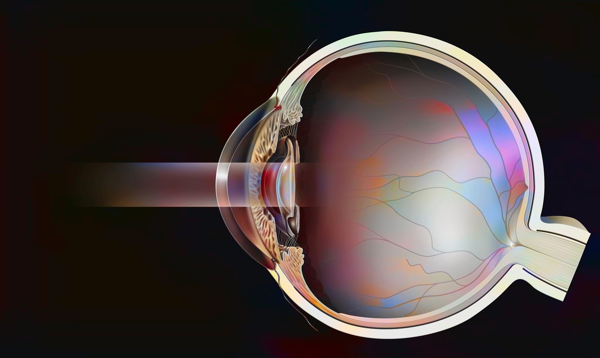 Sectional eye with secondary cataract treated with yag laser