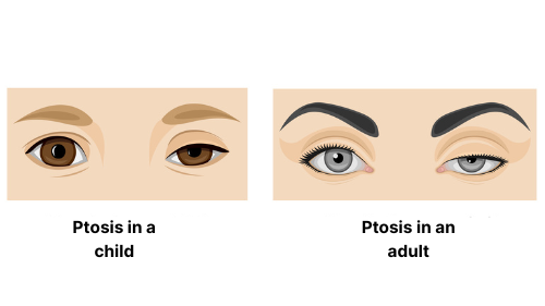 Ptosis symptoms edited