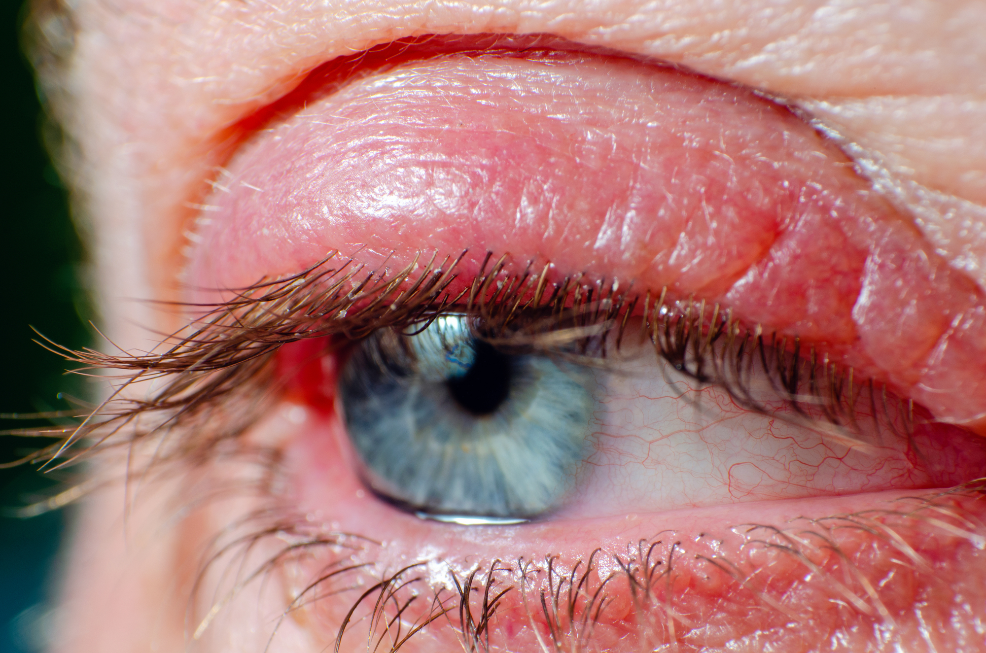 Close-up of a human eye with prominent blue iris and visible eyelashes. The skin around the eye is red and slightly swollen, with discernible fine lines and textures.