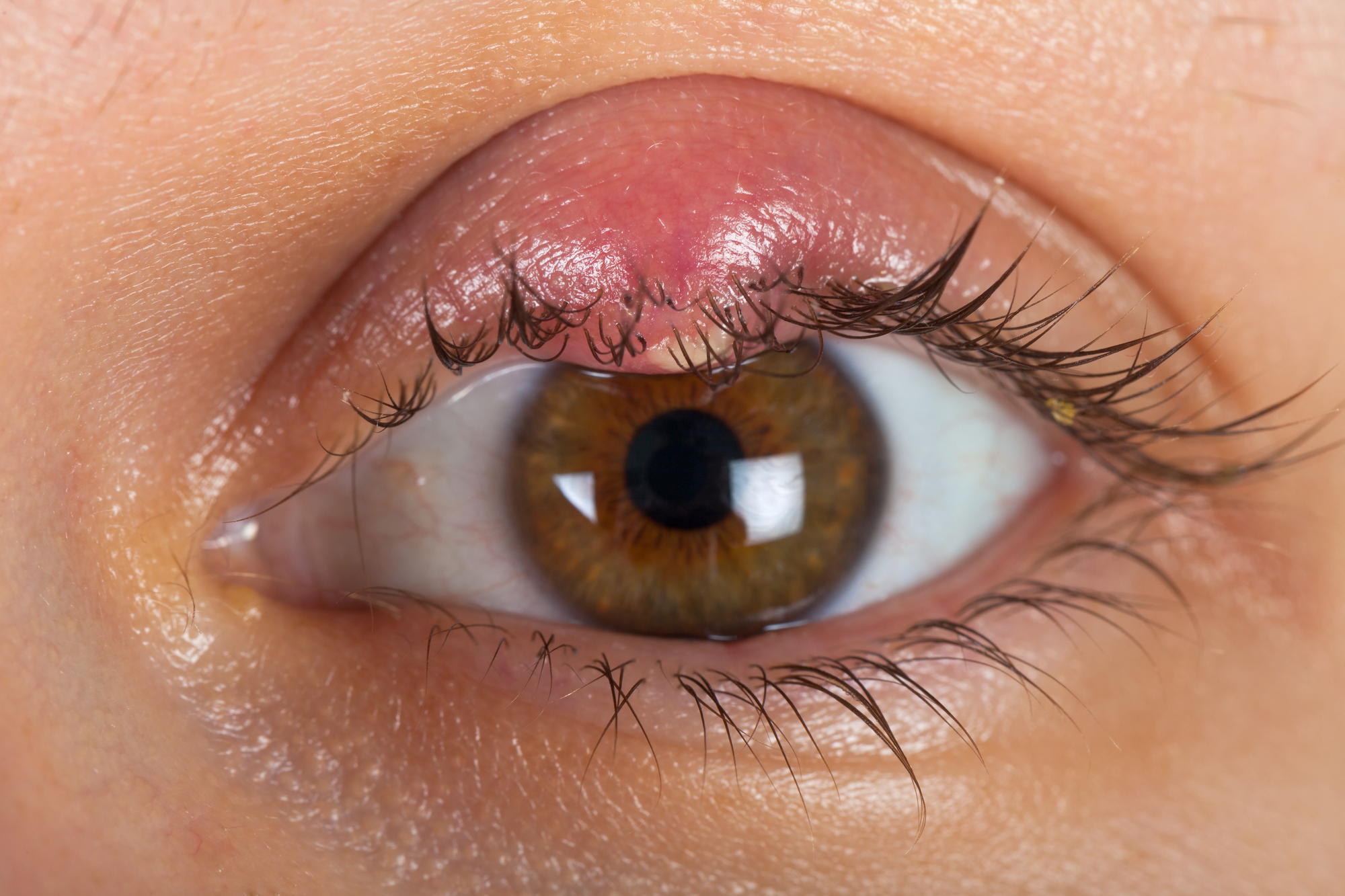 A close-up image of a human eye with a swollen, red bump on the upper eyelid, indicating a stye. The eye is brown with visible eyelashes and skin texture.