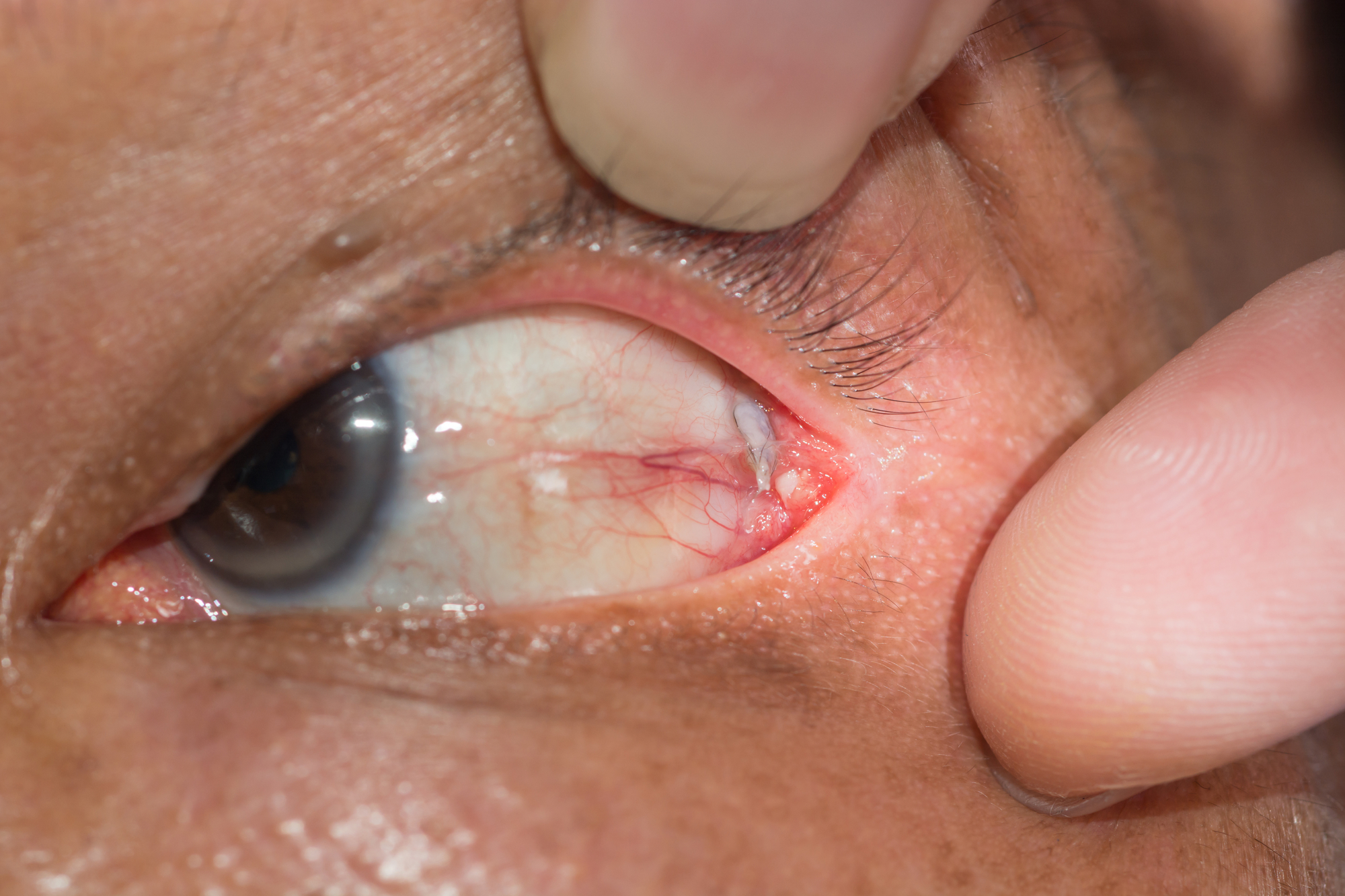 Close-up of an eye with a small lump on the inner corner of the lower eyelid. The surrounding area appears slightly red, and a finger holds the eyelid open to reveal the detail.