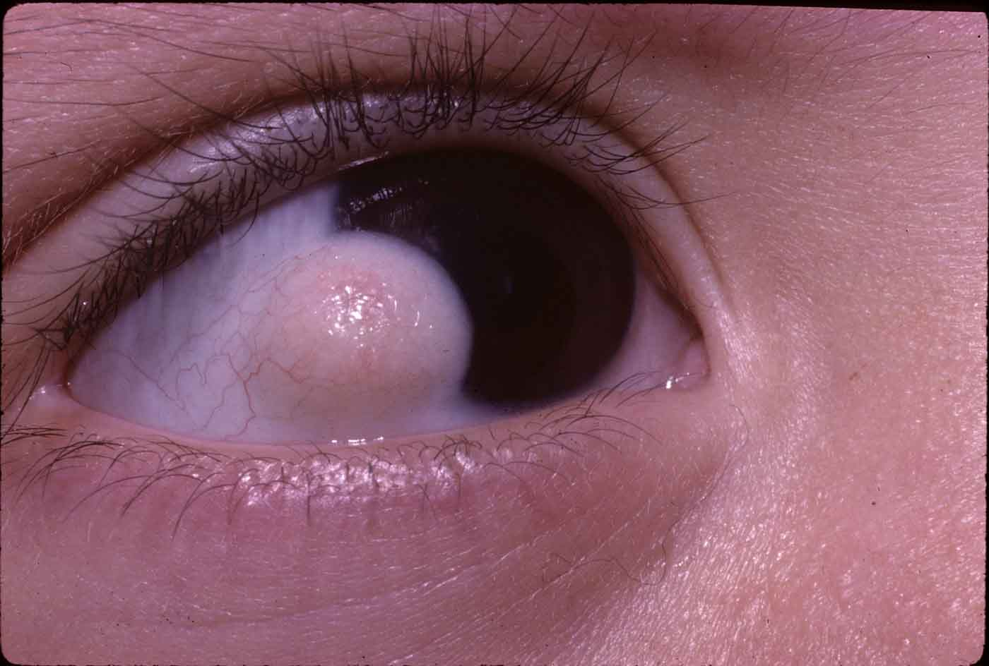 Close-up image of a human eye showing a raised, white lesion on the cornea. The surrounding eye tissue appears normal, with visible eyelashes and eyelids. The lesion is prominent against the dark pupil and iris.