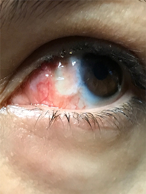 Close-up of a human eye with notable redness and discoloration in the sclera. The iris is visible, and the eyelashes are prominent. The eye appears slightly bloodshot, and there is a visible contrast between the white and red areas.