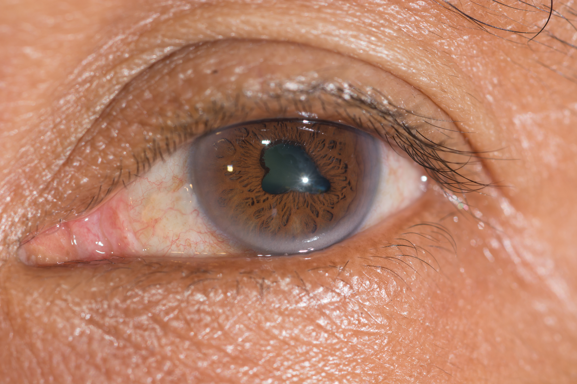 Close-up of a human eye with a light brown iris featuring a distinctive dark cloud-like shape in the center. The surrounding skin appears textured, and the eyelashes are visible on the upper eyelid.