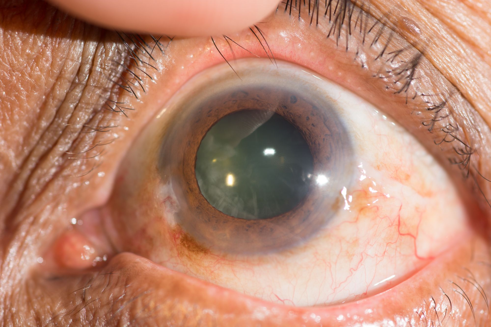 Close-up of a human eye showing a cataract, characterized by a cloudy and opaque lens. The eye has brown and green hues, visible blood vessels, and surrounding skin with eyelashes. A finger is gently pulling the eyelid for a clearer view.