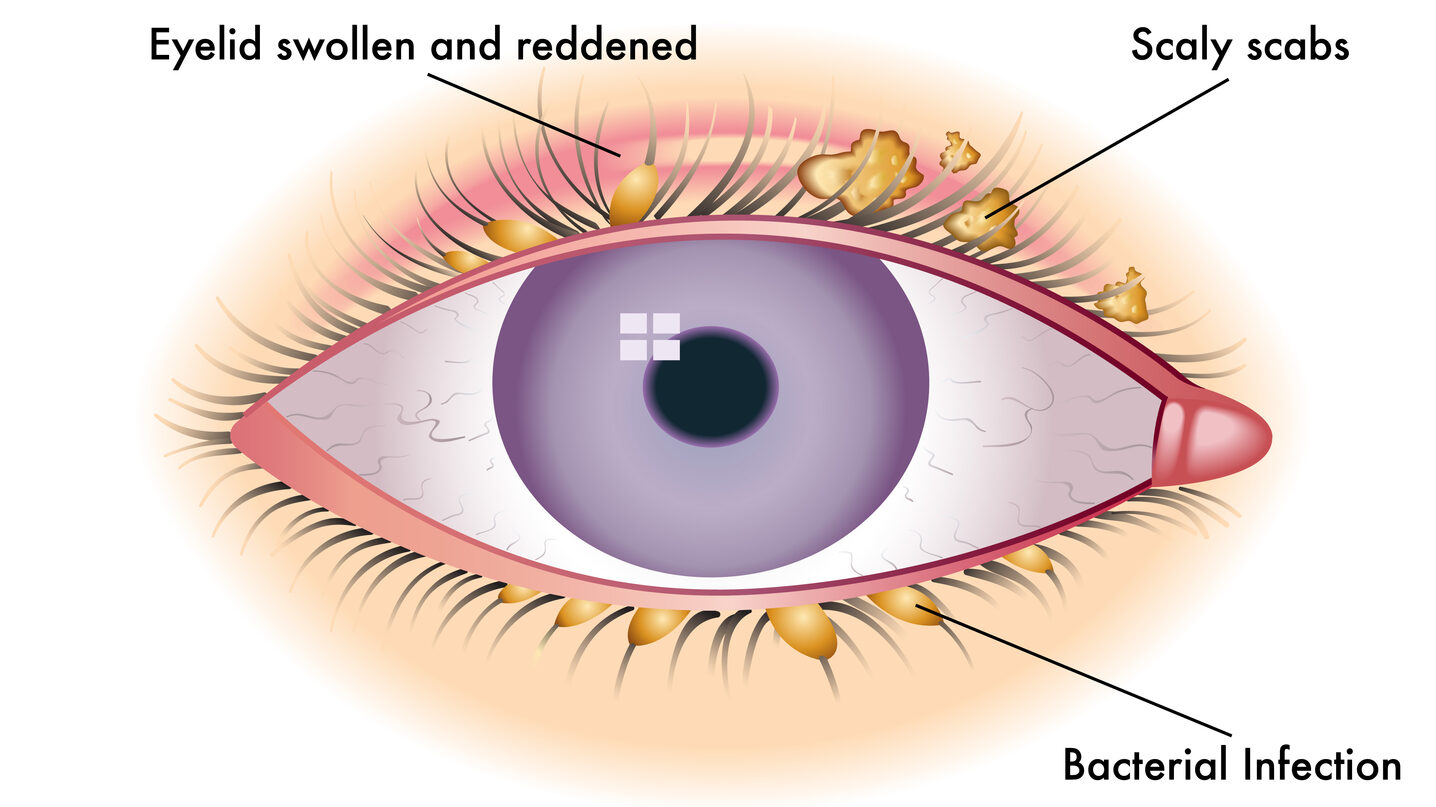 Colorful blepharitis scheme or illustration comparing against a normal eye edited