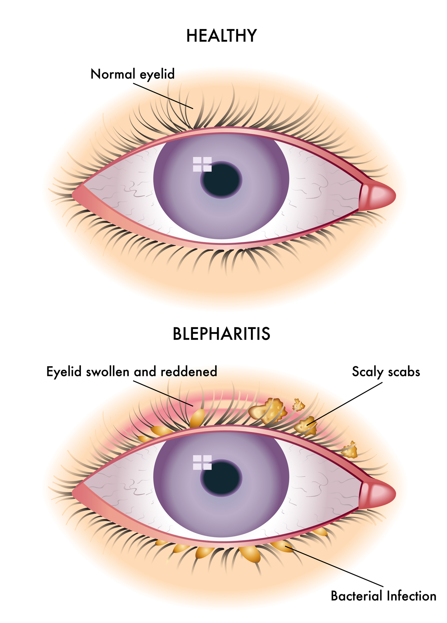 Colorful blepharitis scheme or illustration comparing against a normal eye