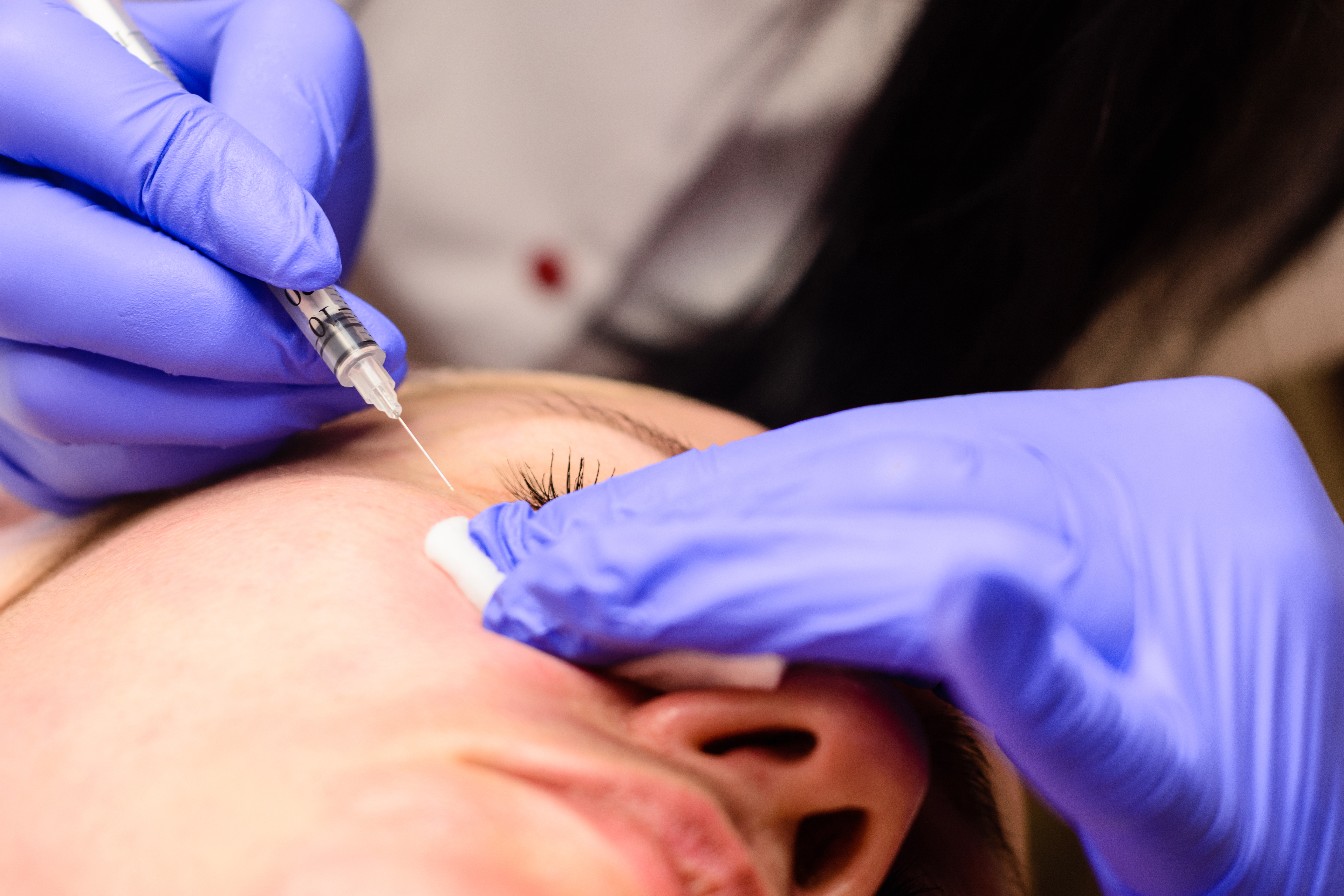 Cosmetologist removes milia on female patient using syringe