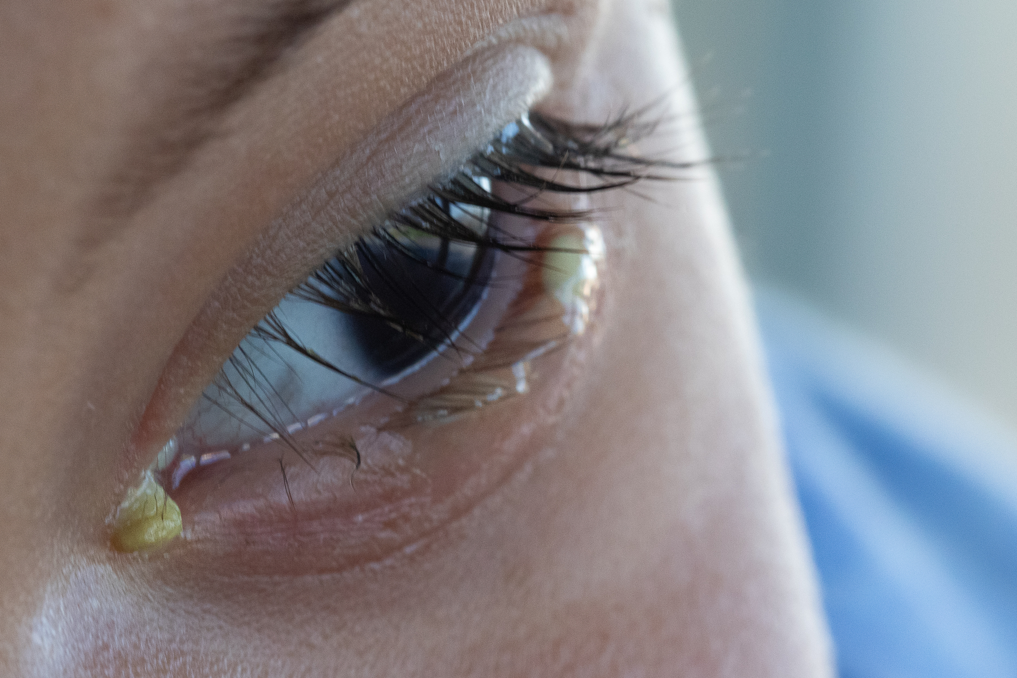 Close-up of a person's eye with visible yellow discharge in the corner. The eyelashes and eyelid are detailed, and the background is out of focus.