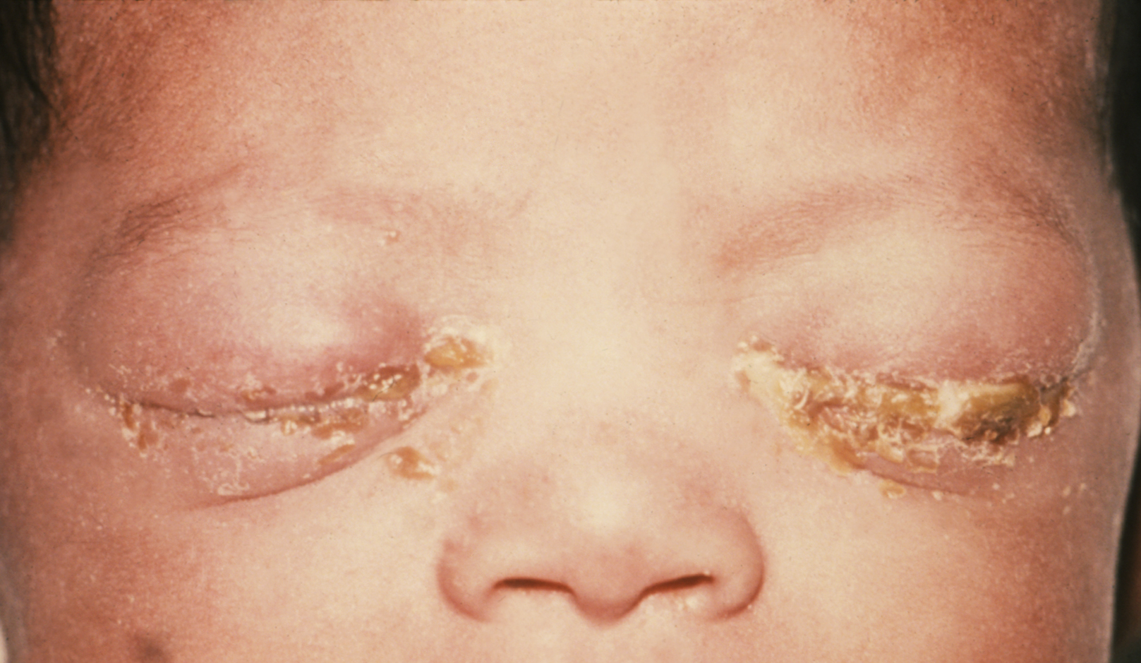 Close-up of a person's eyes covered with crusty, yellowish discharge. The surrounding skin appears inflamed and swollen. The photo focuses on the affected eye area, suggesting an ocular or dermatological condition.