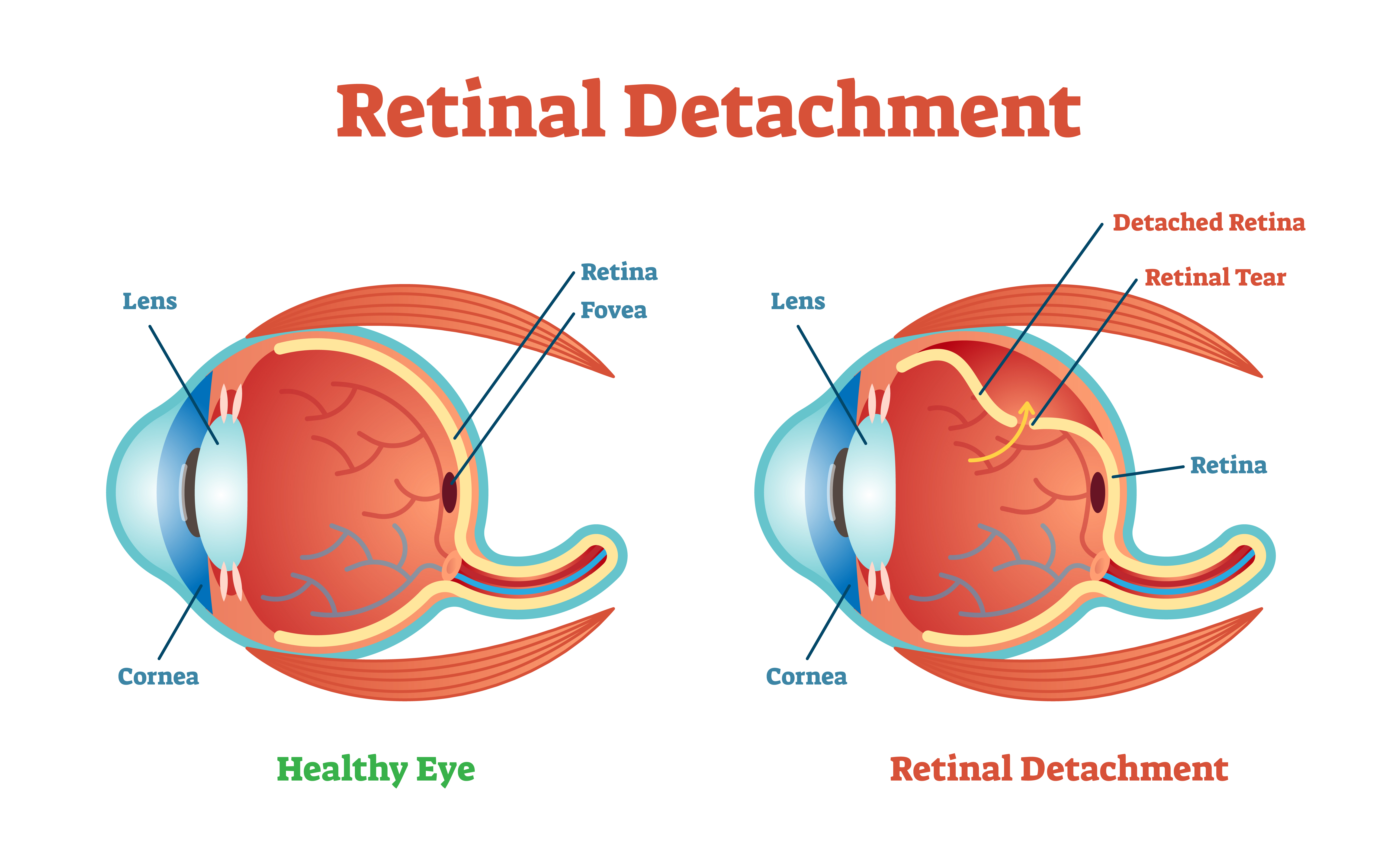 Illustration of a healthy eye vs an eye suffering retinoschisis or retinal detachment or the separation of retina
