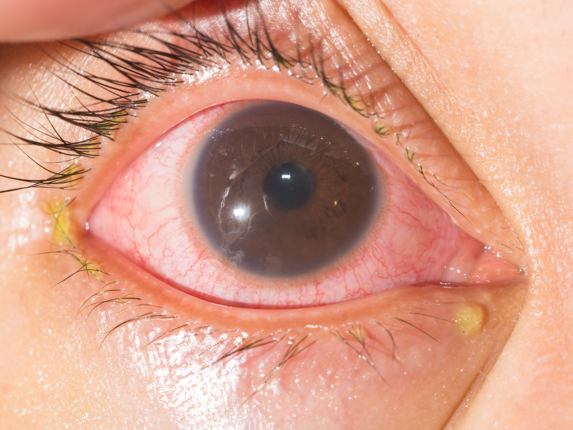 Close-up of a human eye. The sclera appears red with visible blood vessels, and there is a noticeable yellowish discharge in the corner near the tear duct. The eyelashes and the edge of the eyelid are also visible.