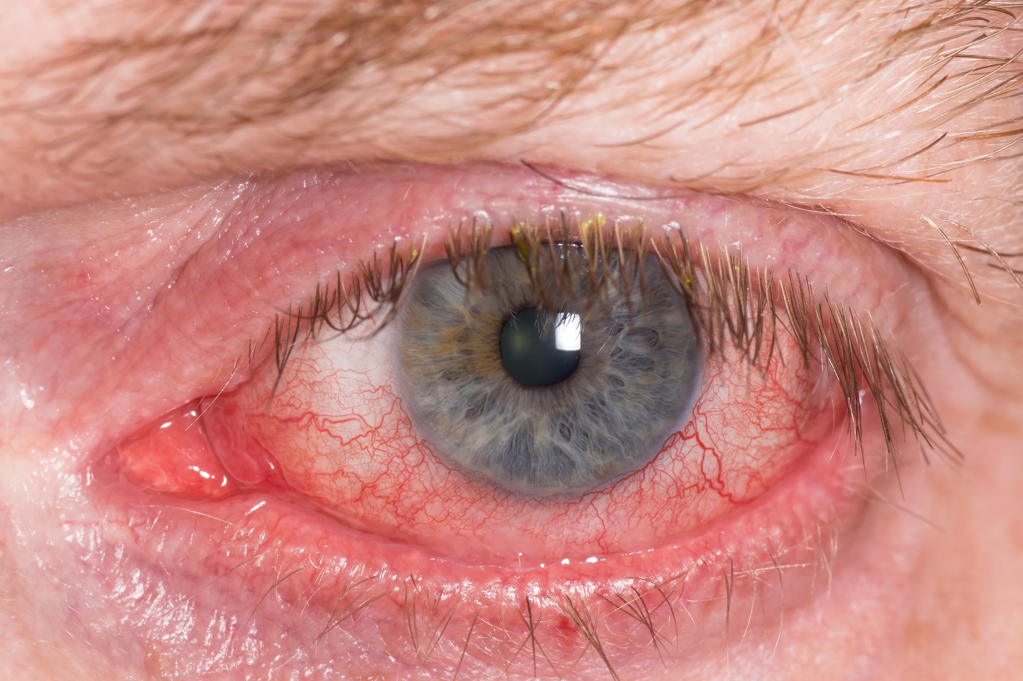 A close-up image of a human eye with a blue iris, showing visible red veins and redness around the white of the eye. The eyelashes and surrounding skin are also visible.