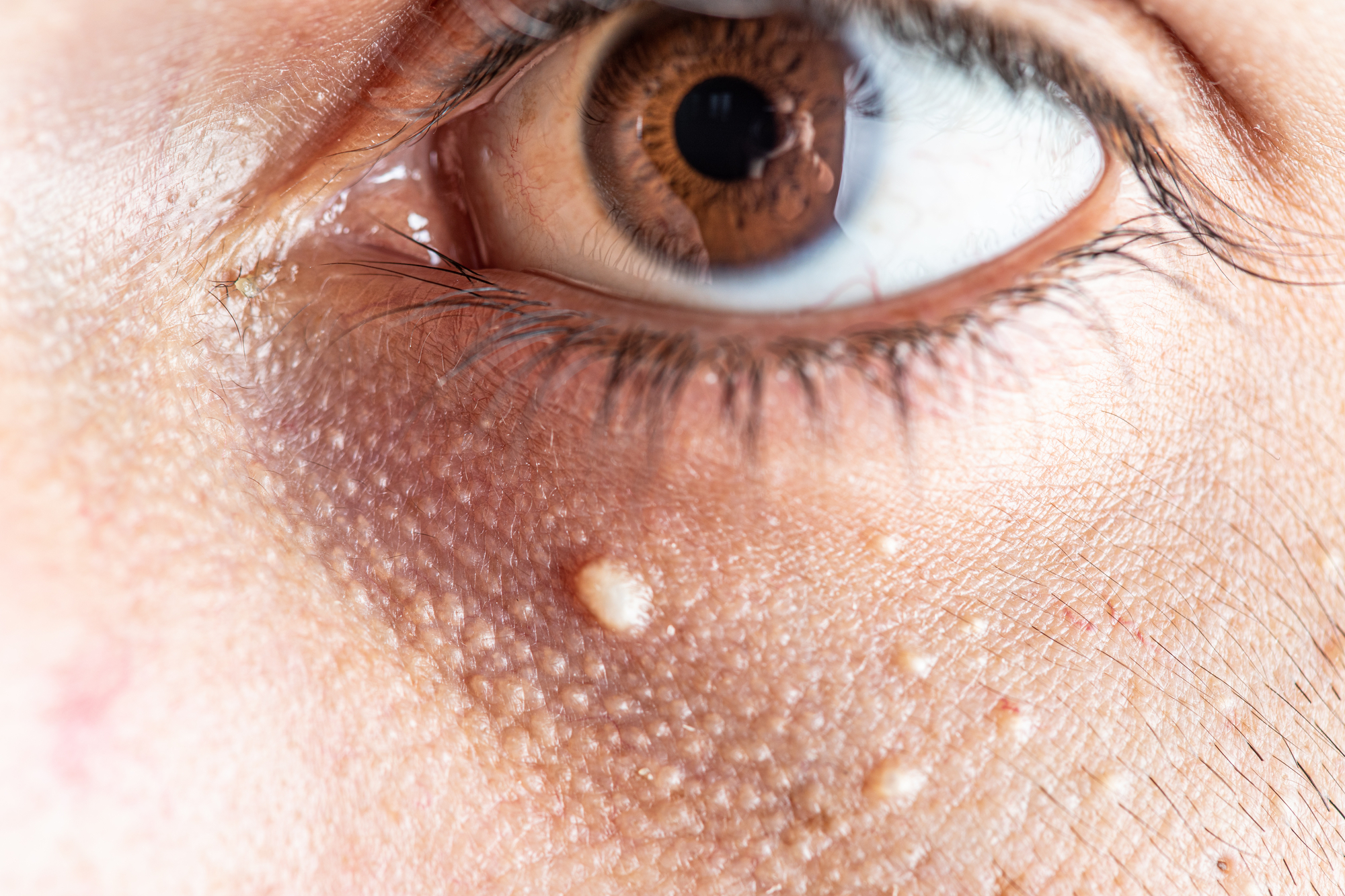 Close-up of a human eye with a brown iris. The skin beneath the eye has small, raised white bumps associated with milia. The texture of the skin and eyelashes are clearly visible.