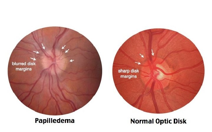 Papilledema vs