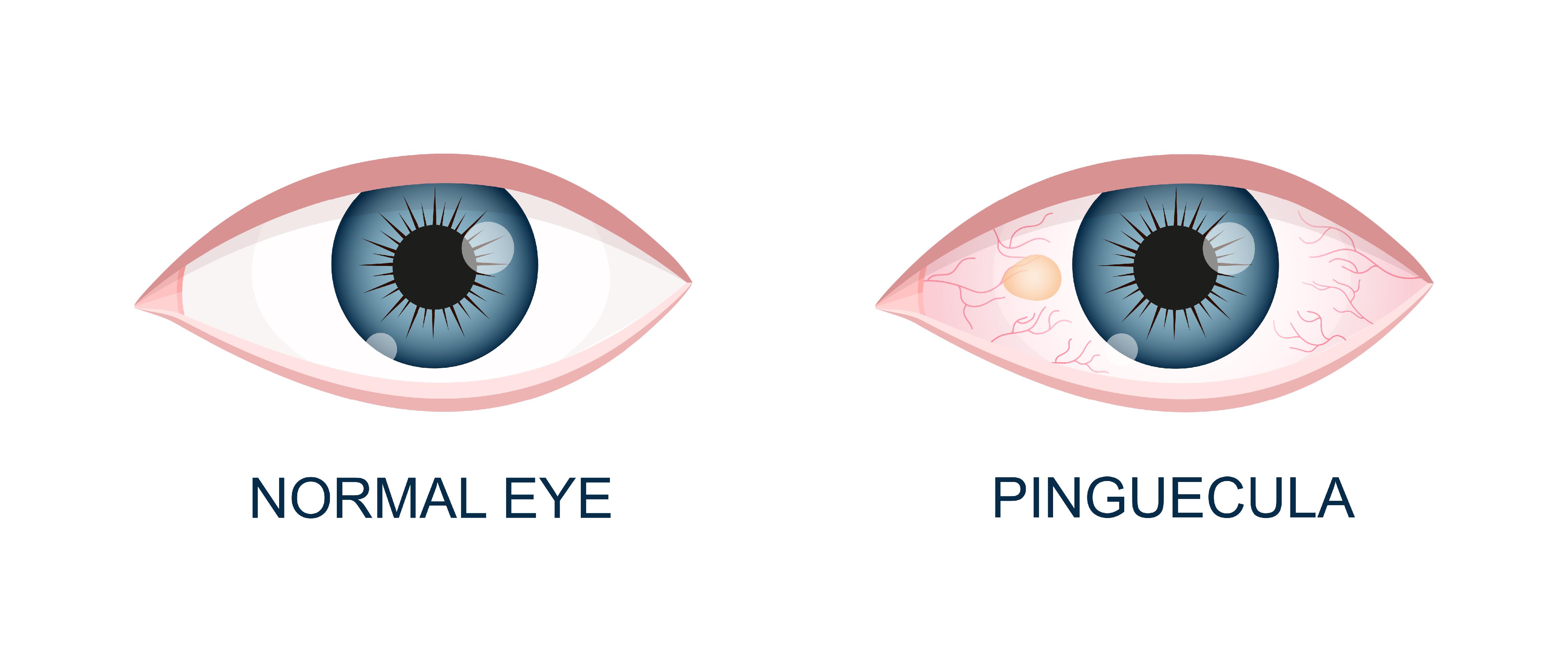 Pinguecula vs normal eye illustration comparison