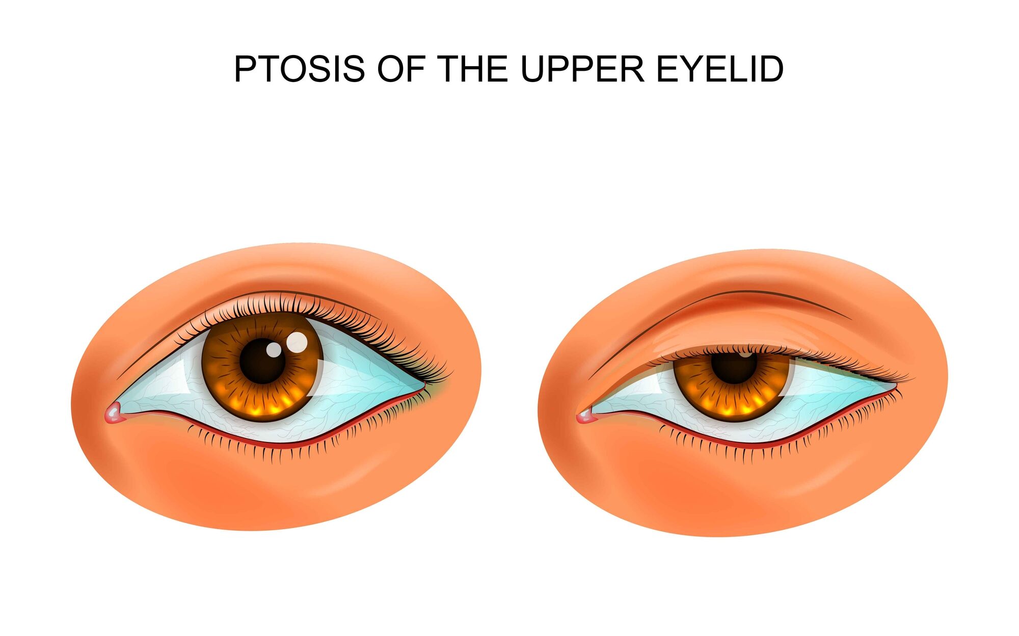 Ptosis or droopy eyelid illustration edited
