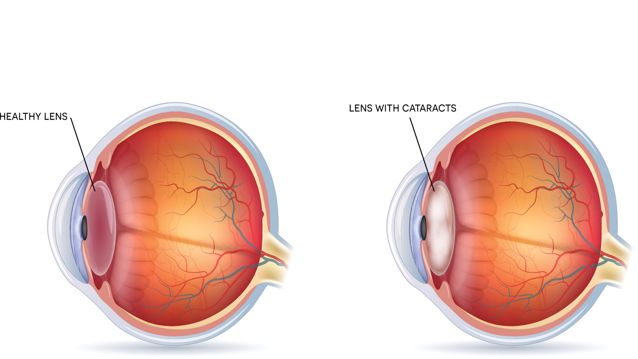 Cataracts