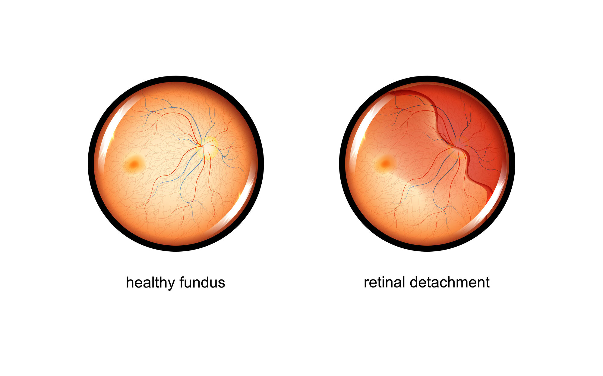 Retinal detachment edited