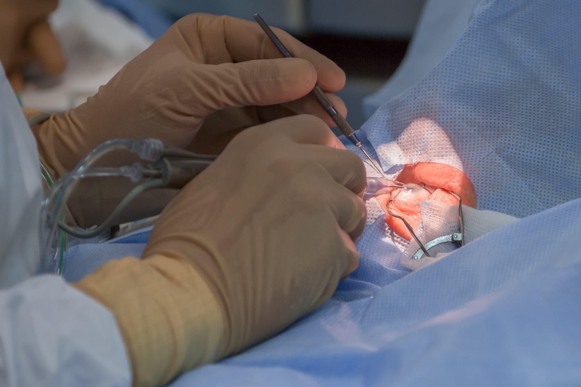 Bimanual cataract extraction with iol implantation