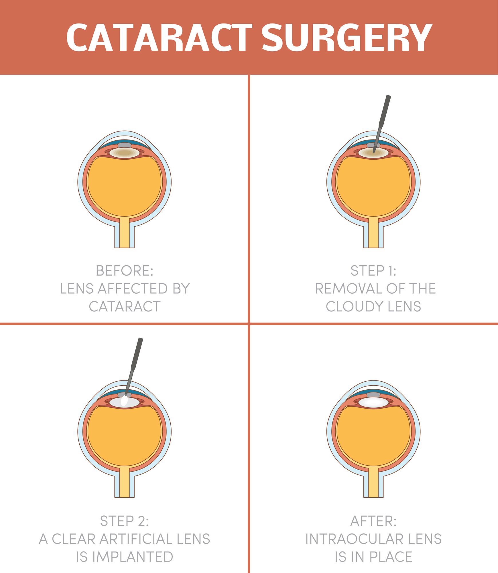 Cataract surgery procedure infographic