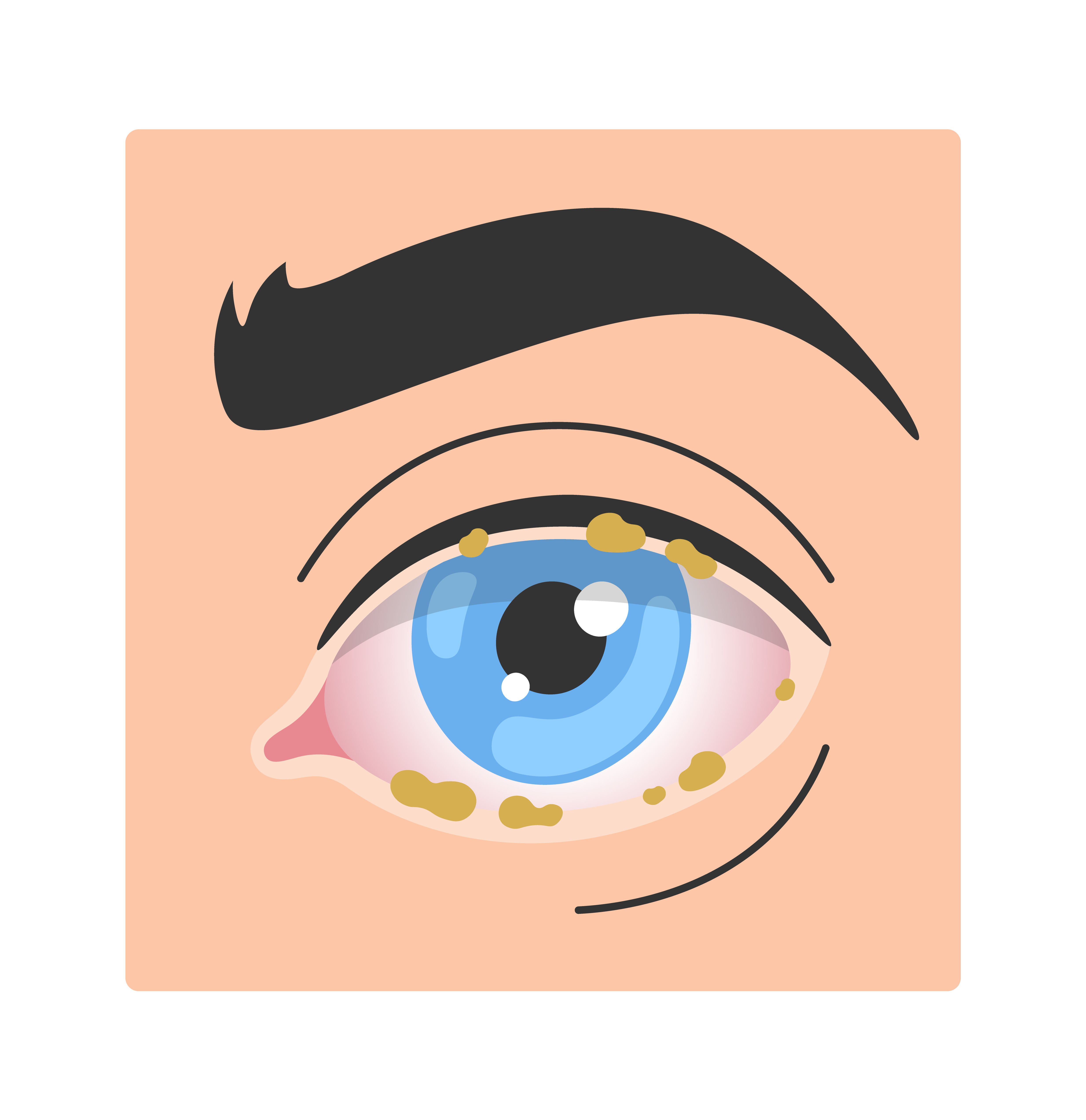 Eye discharge illustration vector
