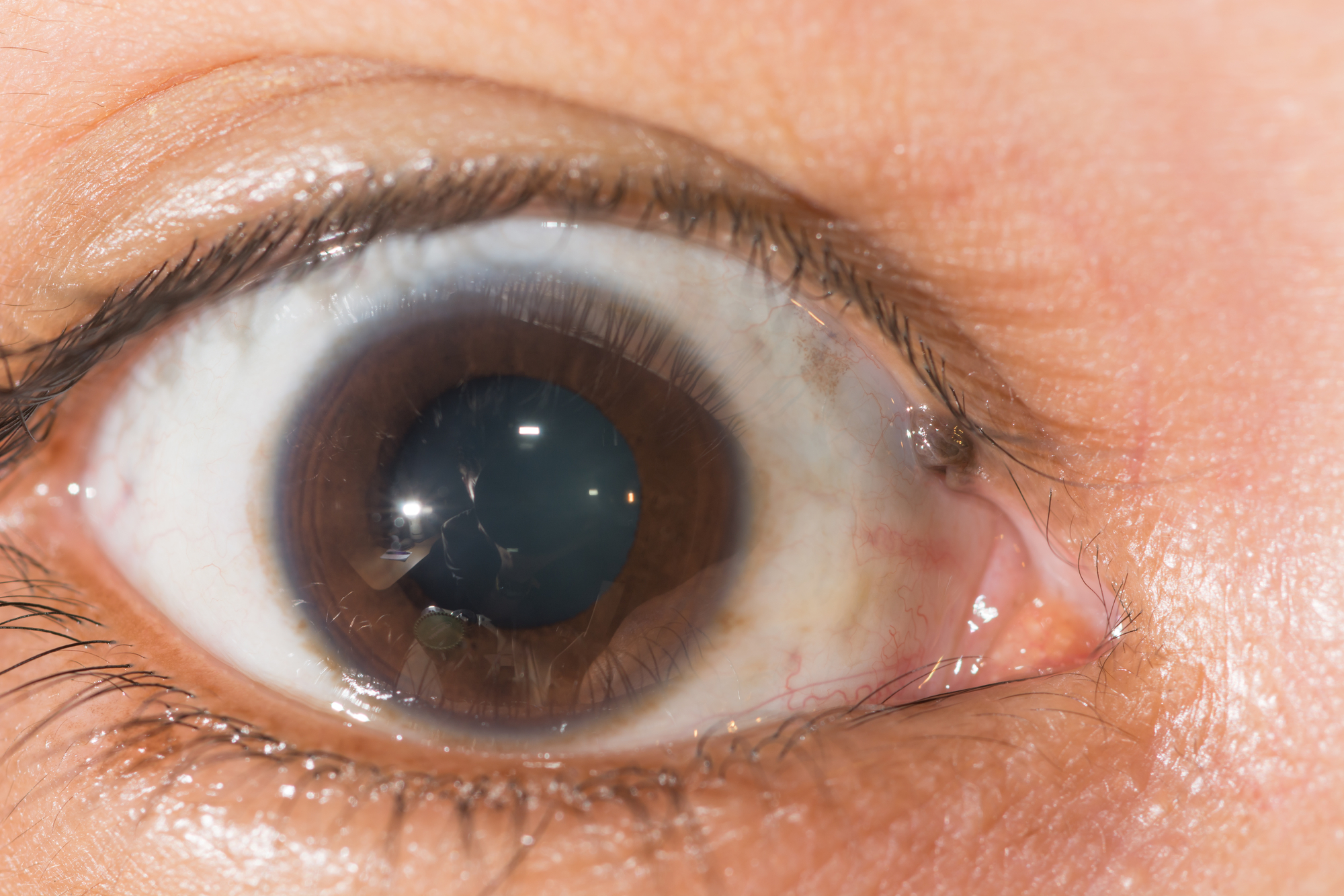 Close-up image of a human eye. The iris is brown, and there is a noticeable, cloudy area over the pupil, consistent with a cataract. The surrounding skin and eyelashes are visible.