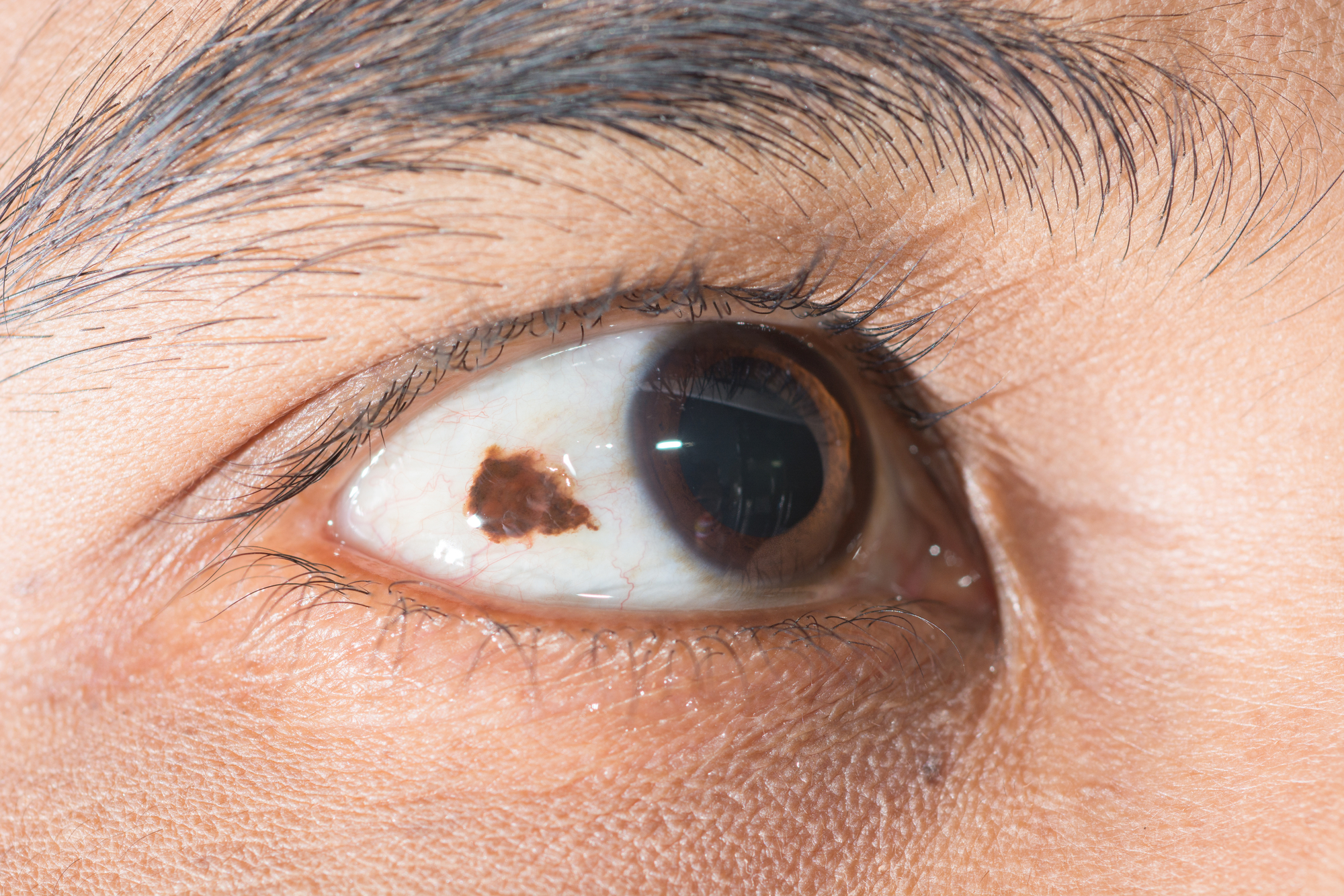 A close-up of a human eye with a noticeable dark brown spot on the sclera. The eye is open and the focus is on the area showing the pigmentation. The surrounding skin and lashes are visible.
