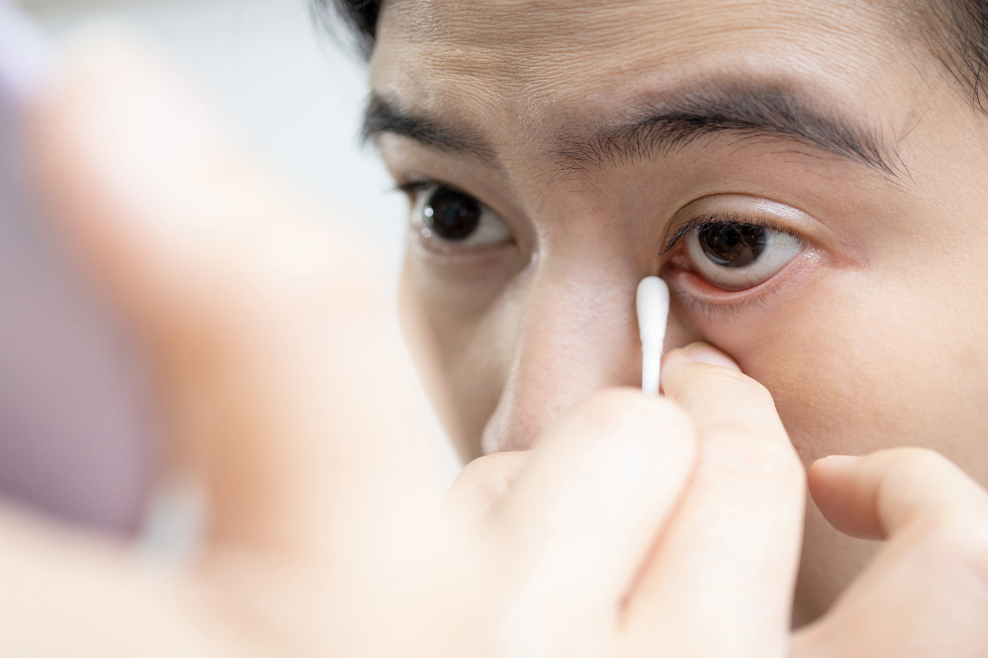 Female using a cotton bud swab to wipe clean the swollenitchy area of an eyelid