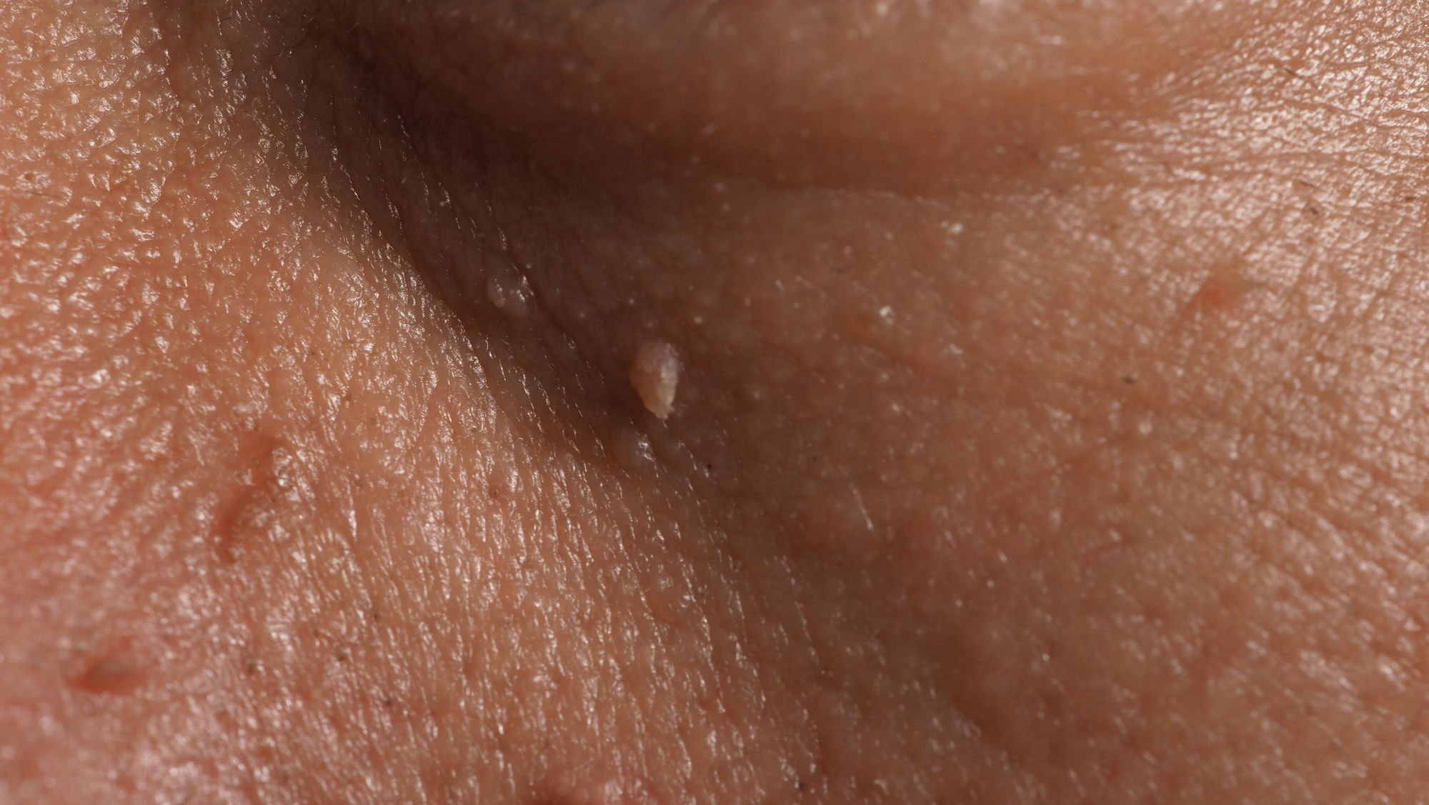 Macro shot of skin tags formed under the eye of an unknown senior