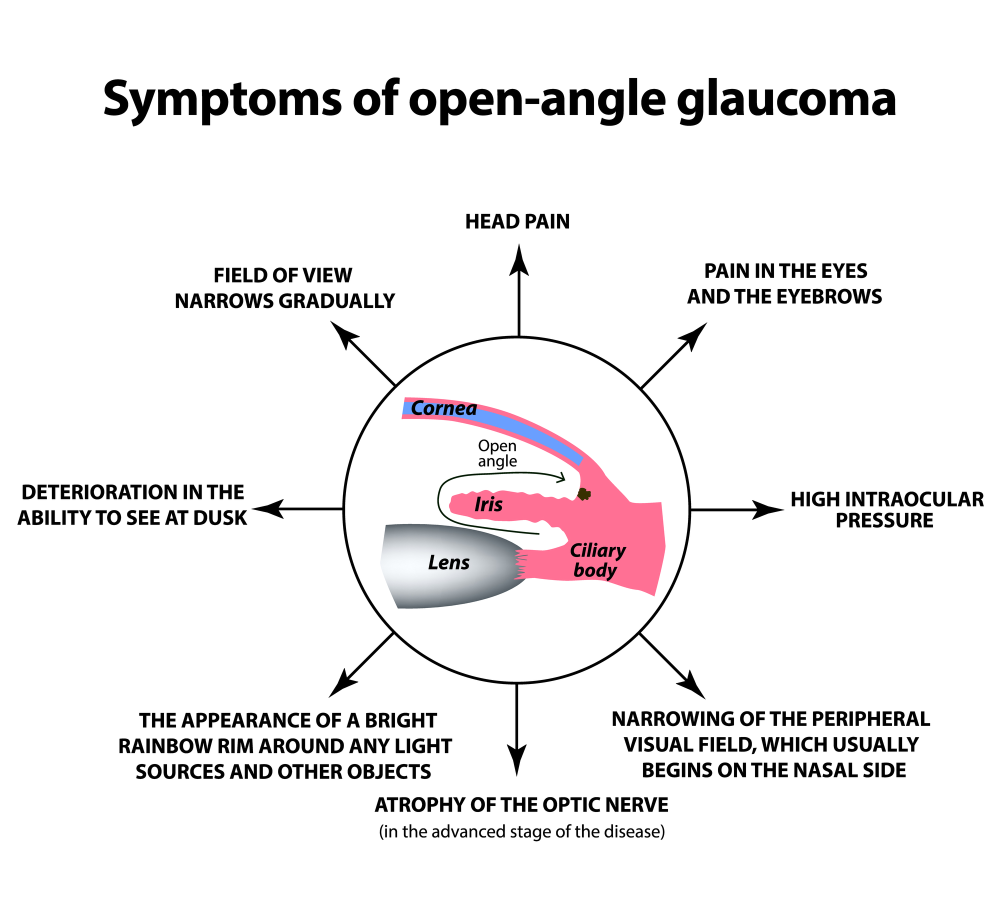 Symptoms of open angle glaucoma